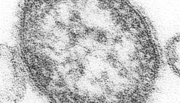 virus del morbillo al microscopio elettronico